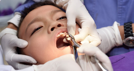 Tooth Extraction