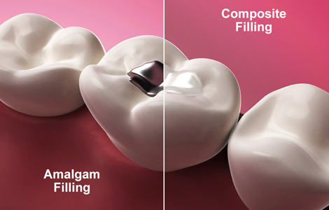 Dental Fillings & Restoration